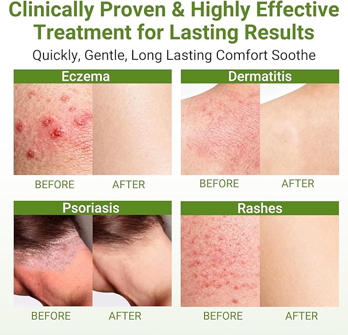 Eczema Cream, Psoriasis, Dermatitis & Rashes Treatment, Moisturizer for Dry, Itchy & Sensitive Skin, Face, Scalp & Body Soothing, Eczema Relief for Kids & Adults, 3.53 OZ