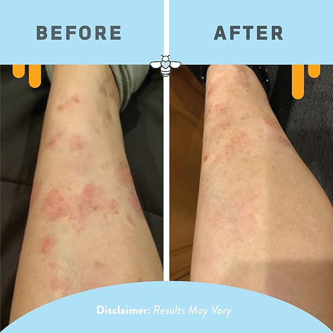 PSORIASIS HONEY Daily Moisturizing Body Lotion - Eczema & Seborrheic Dermatitis Cream for Itchy & Flaking - Moisturizing Psoriasis Treatment for Skin (16oz)