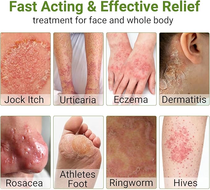 Eczema Cream, Psoriasis, Dermatitis & Rashes Treatment, Moisturizer for Dry, Itchy & Sensitive Skin, Face, Scalp & Body Soothing, Eczema Relief for Kids & Adults, 3.53 OZ