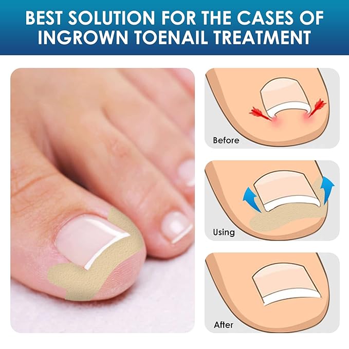 Ingrown Toenail Treatment, 50Pcs Breathable Ingrown Toenail Corrector Patches with Nail File & Lifter, Professional-Grade Treatment for Fast Results