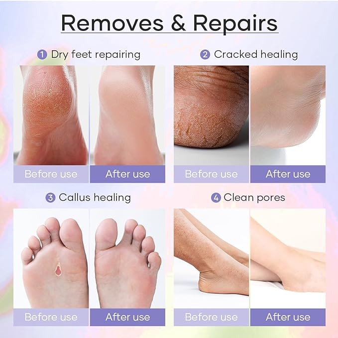Epsom Salt Soak, Callus Remover Gel, Extreme Sugar Scrub, Collagen Mask & Shea Butter Lotion – Professional Spa Foot Care System 5 Step Luxury Pedicure Kit. Milk & Honey 50 Set